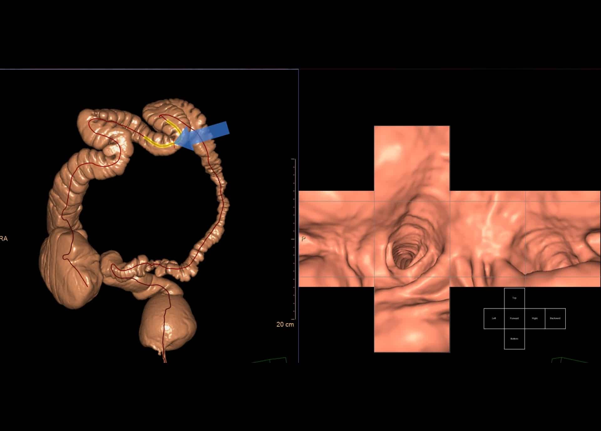 Coloscopie virtuelle | Centre de radiologie IRM et scanner | Imagerie médicale HPA | Antony