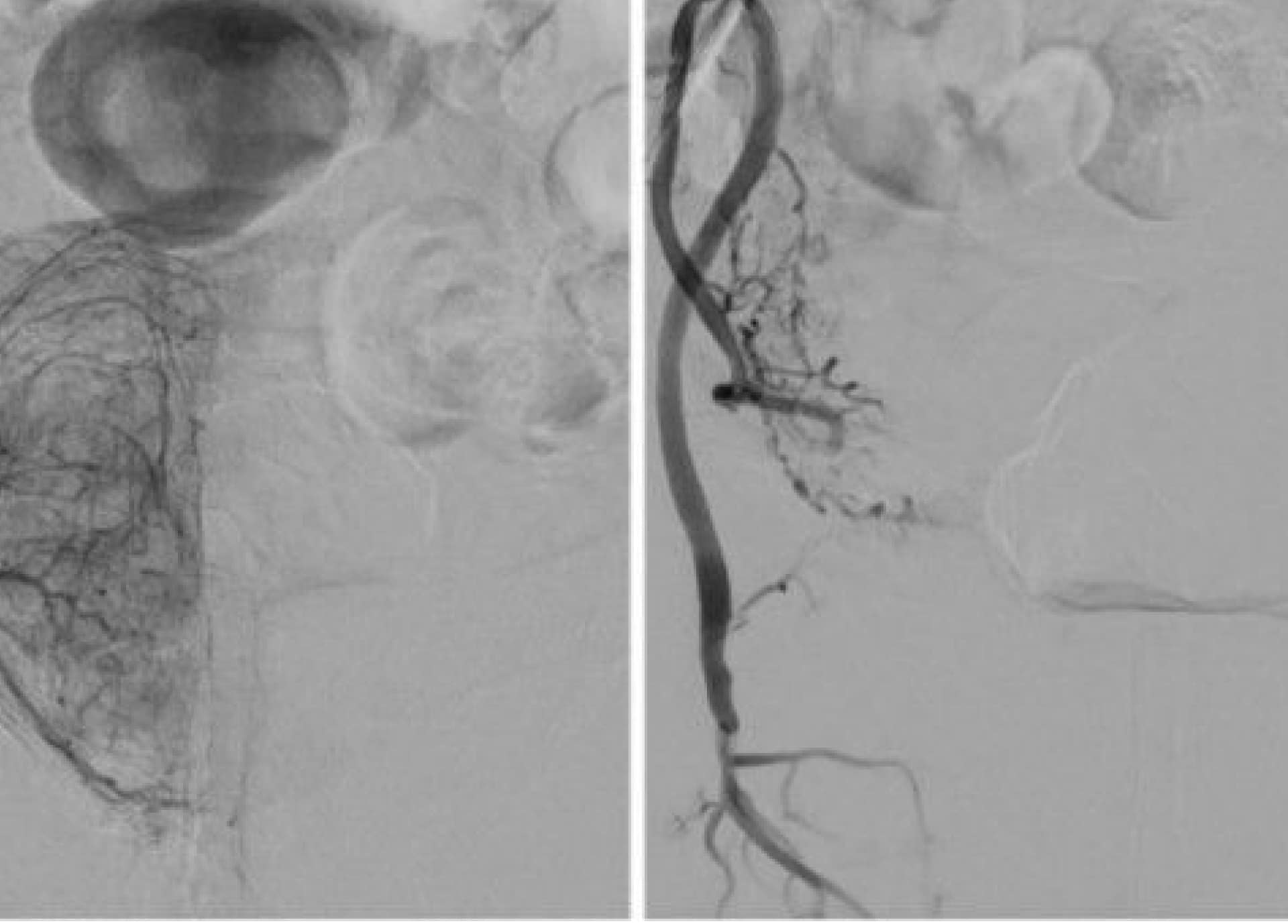 Embolisation | Centre de radiologie IRM et scanner | Imagerie médicale HPA | Antony